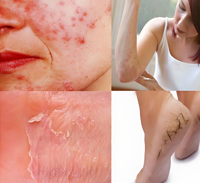 Homeopathic treatment for skin problems like eczema, psoriasis, acne at Nagraja Homeopathy clinic